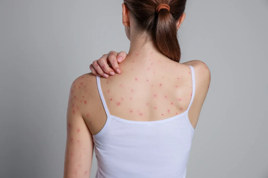 Person with red hives and irritated skin on the back